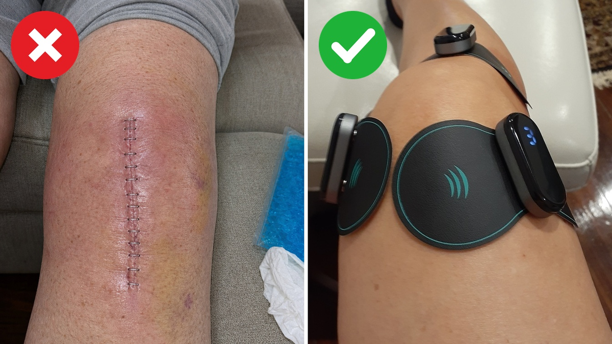 Before and after — a swollen knee with a fresh knee-replacement scar, next to a real customer's knee wearing Vibit PULSE